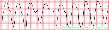 Flatlining