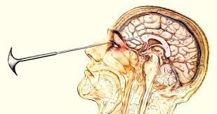 lobotomy