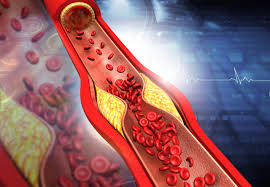 atherosclerosis