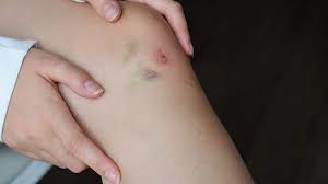 clotting disorder