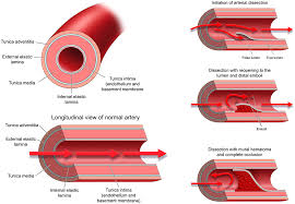 arterial dissection