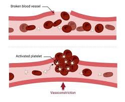 coagulopathy