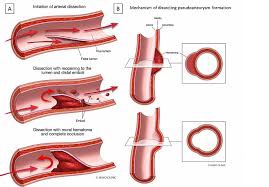 arterial tear