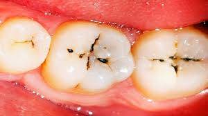 cavity