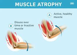 ATROPHY